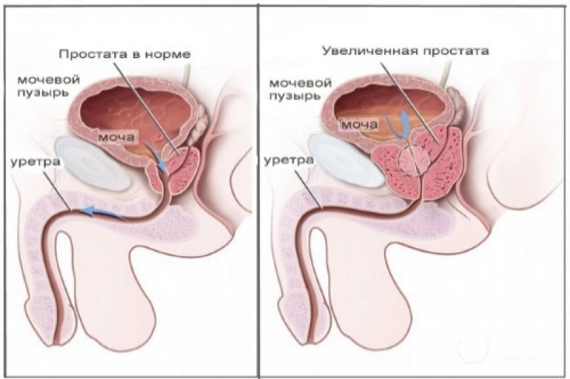 Туберкулез простаты