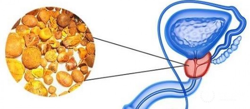 Камни предстательной железы