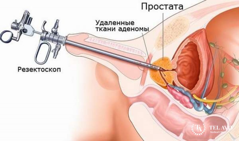 Трансуретральная резекция (ТУР) аденомы простаты