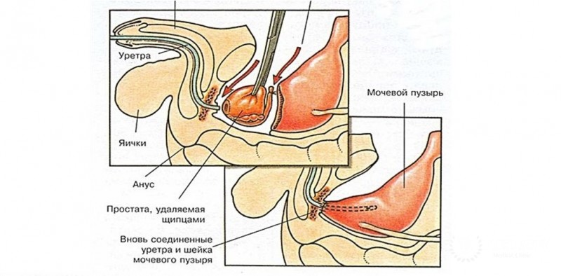 Лапароскопическая радикальная простатэктомия