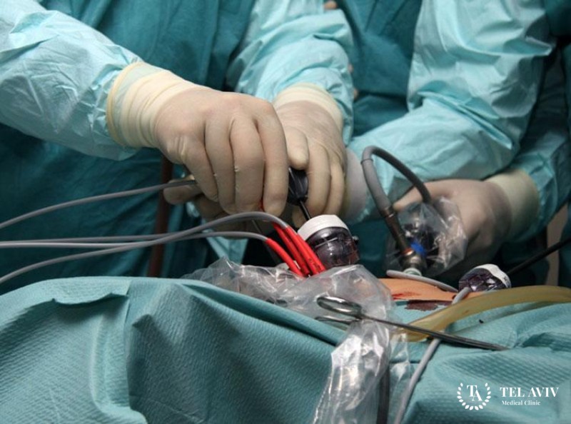 Криоабляция предстательной железы