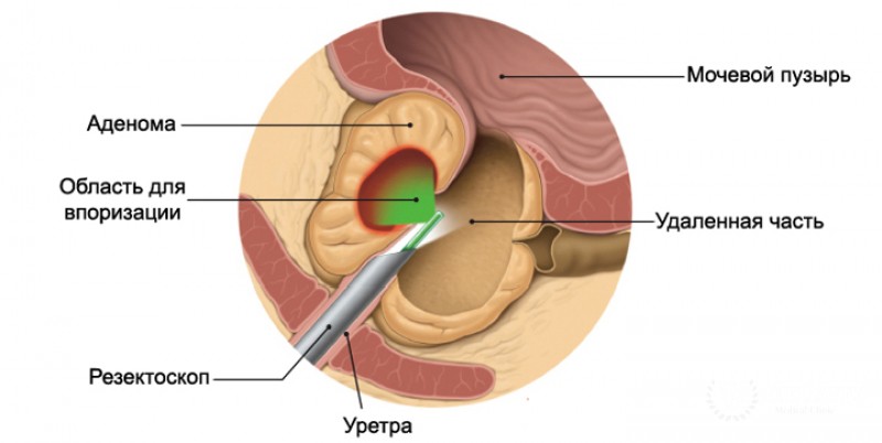 Лазерное эндоскопическое удаление аденомы простаты