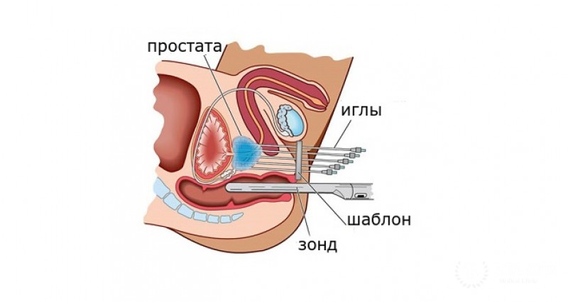 Брахитерапия предстательной железы