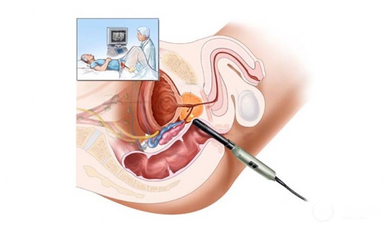 Биопсия предстательной железы