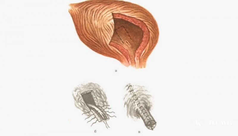 Уретероцистонеостомия (реимплантации мочеточника в мочевой пузырь)