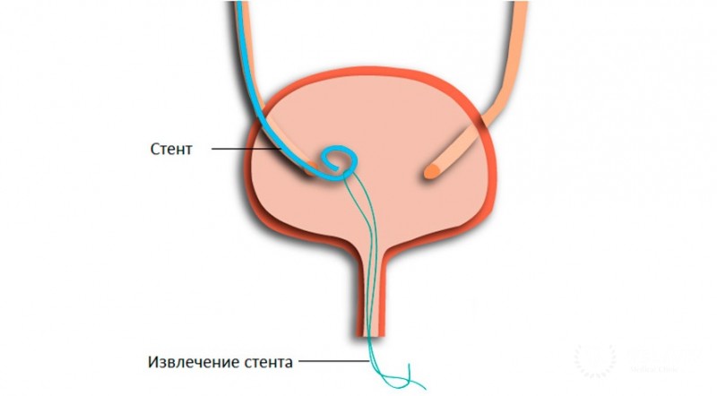 Стентирование мочеточника