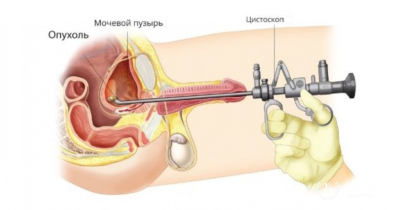 Аденокарцинома мочевого пузыря: описание, причины