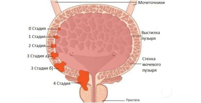Переходно-клеточный рак мочевого пузыря: симптомы, диагностика
