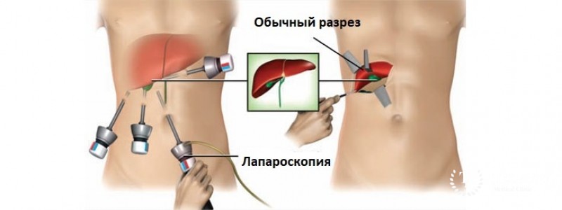Лапароскопическая резекция печени
