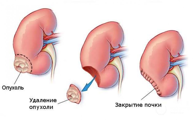 Лапароскопические операции почки
