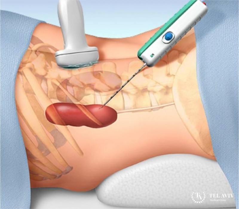 Биопсия почки. Способы проведения процедуры.