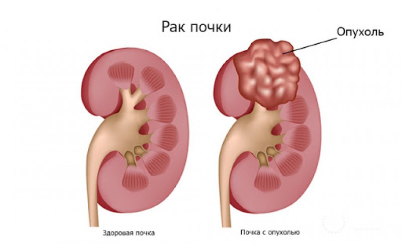 Раковые заболевания почек