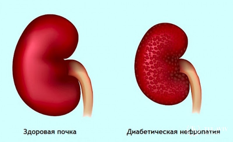 Диабетическая нефропатия