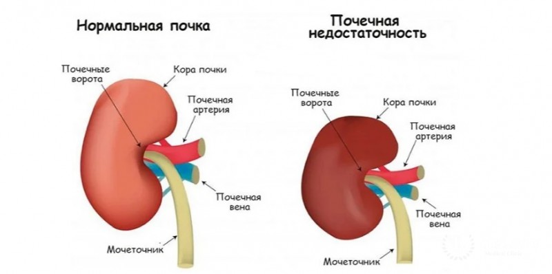 Почечная недостаточность