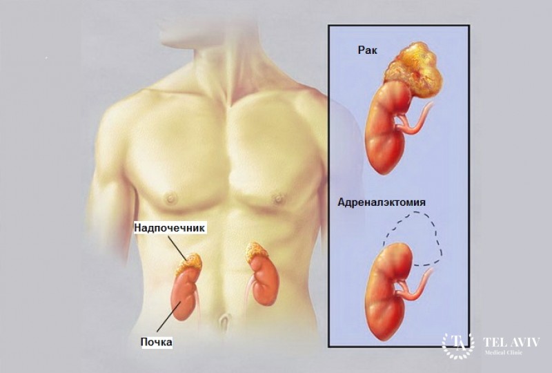 Адреналэктомия