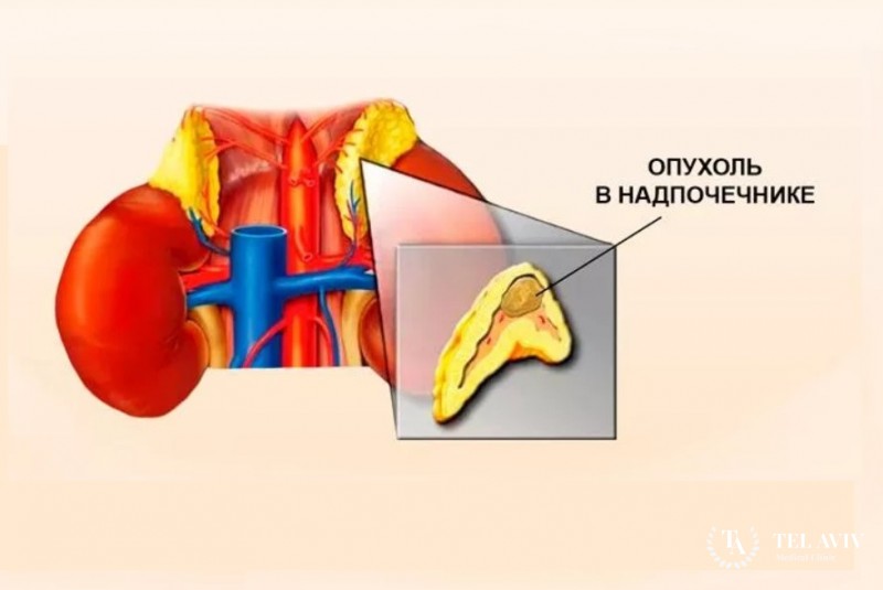 Раковые заболевания надпочечников