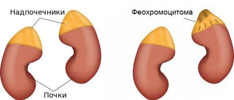 Фе́охро́моцито́ма