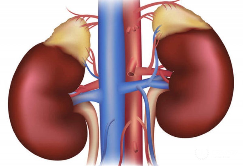 Кортикоандростерома надпочечника