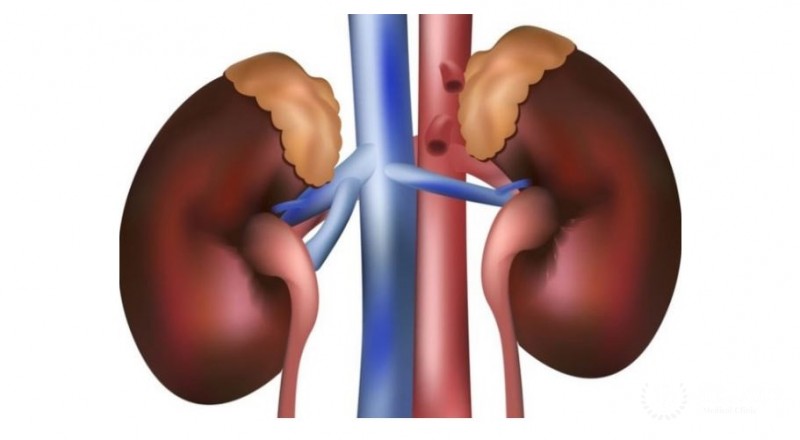 Двусторонняя гиперплазия надпочечников