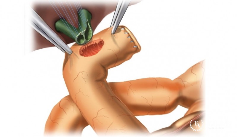 Восстановление и реконструкция желчного протока