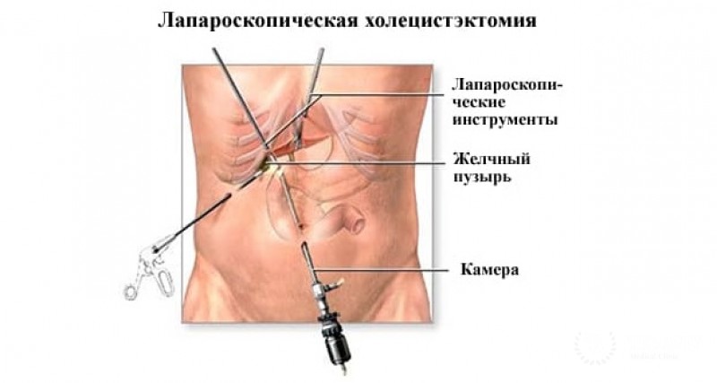 Лапароскопия холецистэктомия