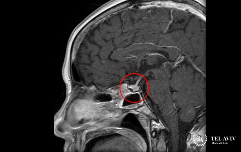 Кортикотропинома: информация
