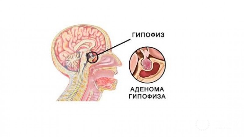 Тиреотропинома: информация