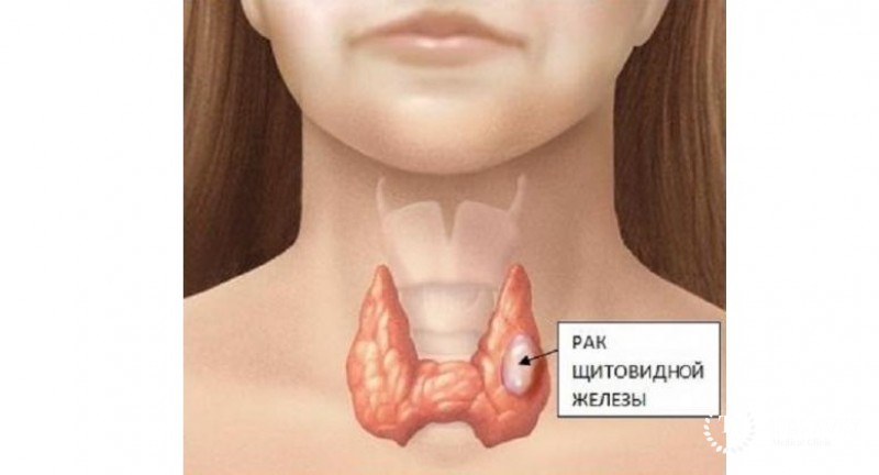 Аденомы щитовидной железы