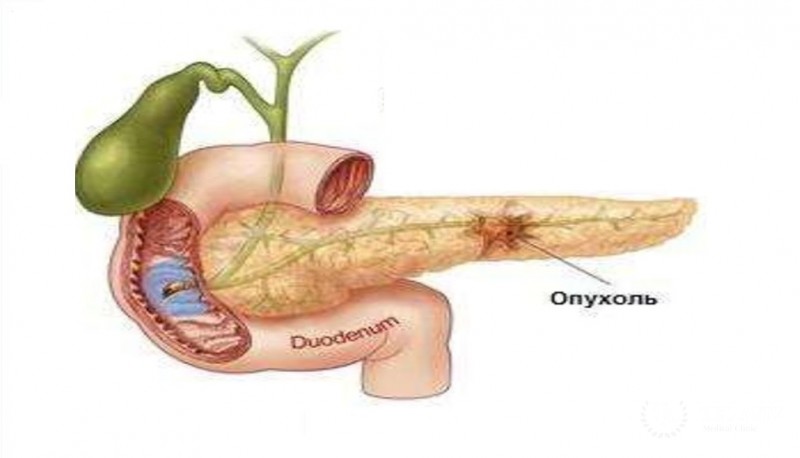 Випома поджелудочной железы