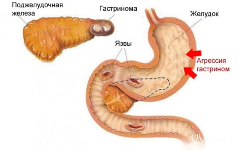 Гастринома поджелудочной железы