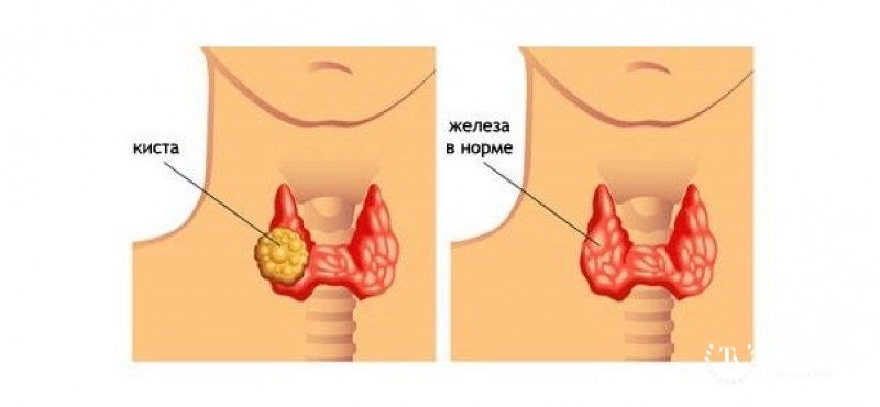 Киста щитовидной железы