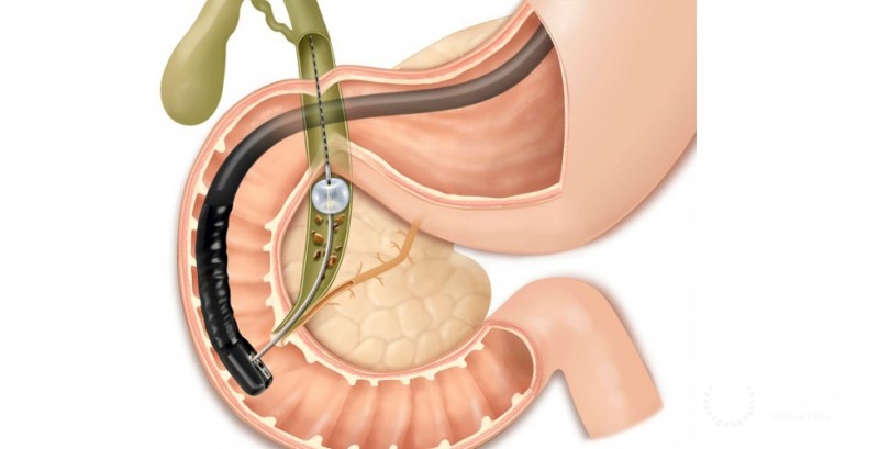 Эндоскопическая ретроградная холангиопанкреатография (ЭРХПГ)