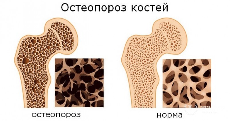 Остеопороз