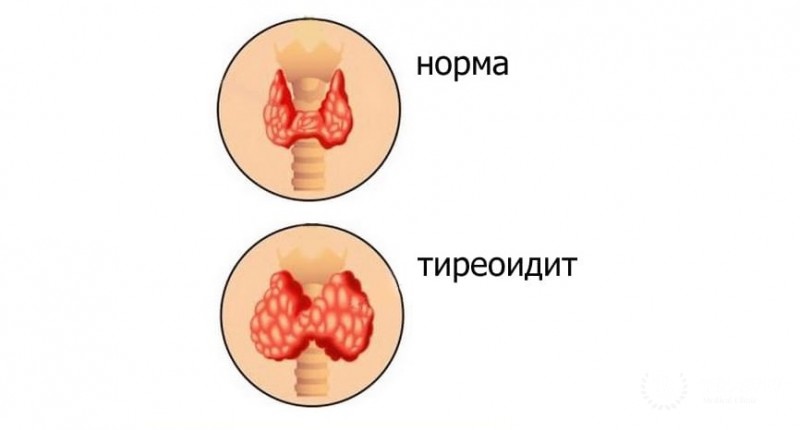 Тиреоидит Хашимото