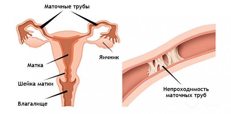 Непроходимость маточных труб: симптоматика