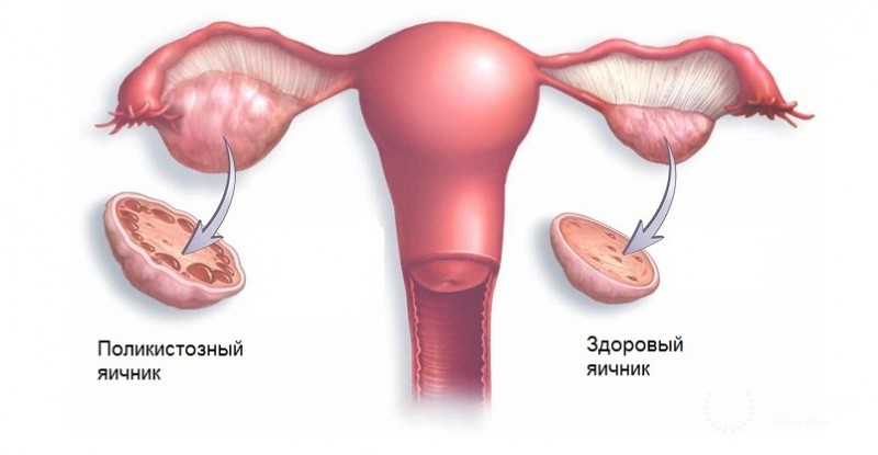 Поликистоз: симптоматика, методы диагностики