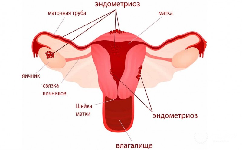 Эндометриоз: симптоматика, причины