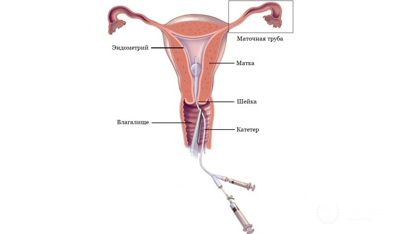 Гистеросальпингография (HSG): информация