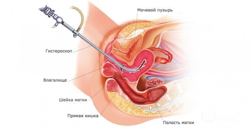 Гистероскопия: информация