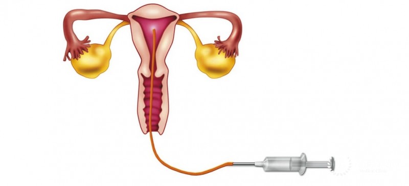 Внутриматочная инсеминация: полная информация