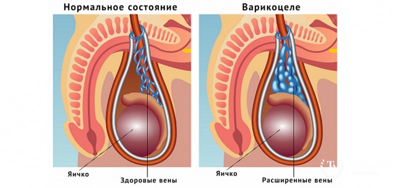 Варикоцеле: информация
