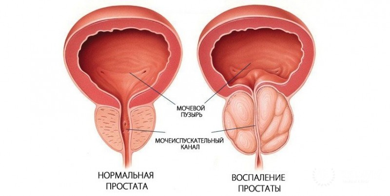Воспаление простаты, мочеточников: информация