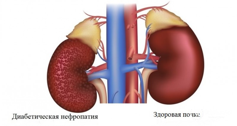Диабетическая нефропатия: информация