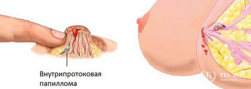 Внутрипротоковая папиллома молочной железы: информация