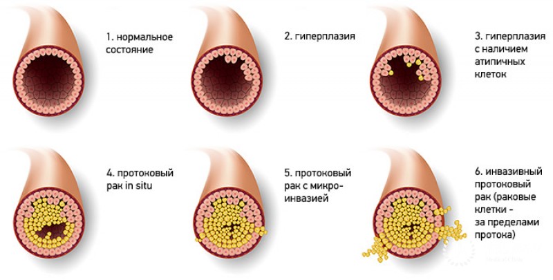 Внутрипротоковый рак in situ молочной железы: информация