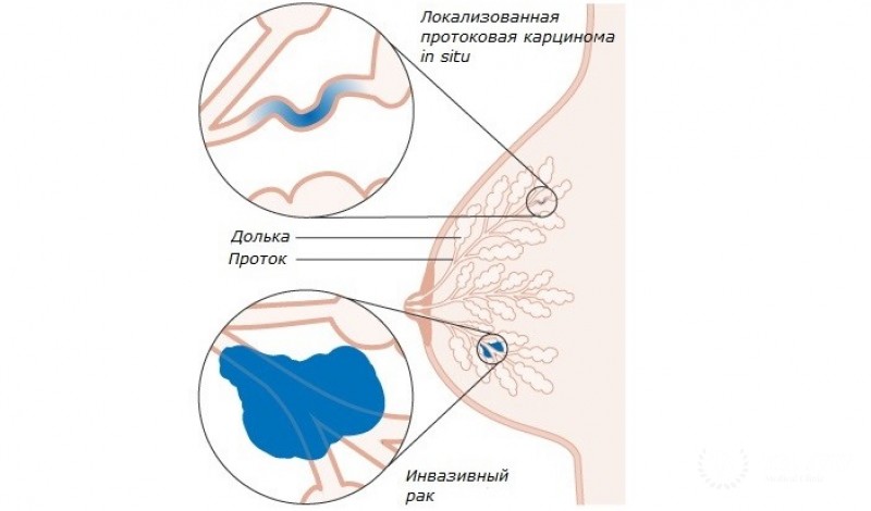 Дольковый рак in situ молочной железы: информация