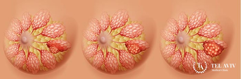 Инвазивный дольковый рак молочных желез: информация