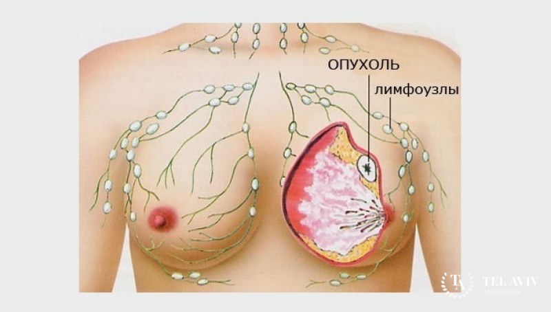 Рак молочной железы с признаками воспаления: информация