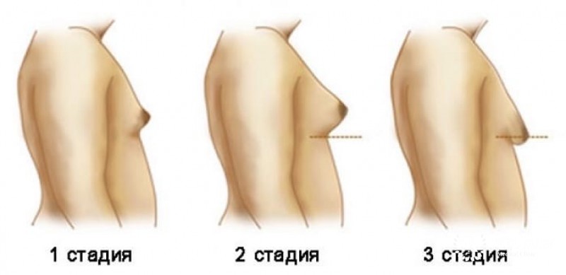 Гинекомастия: информация