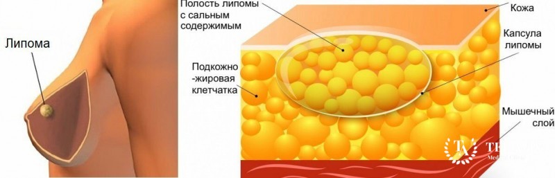Липома молочной железы - информация